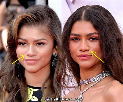 zendaya nose job|zendaya surgery.